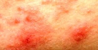 異位性皮膚炎/過敏性濕疹-中醫談異位性皮膚炎分三類型對症調理助改善異位性皮膚炎!