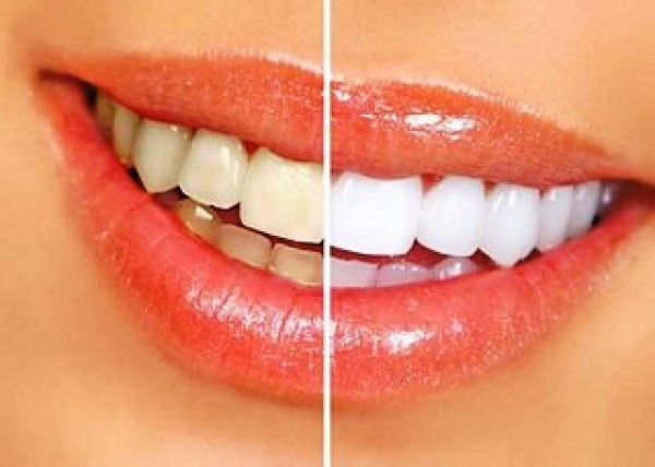 牙齒美白-十種天然的牙齒美白方法:美白牙齒讓你盡情展露動人微笑!