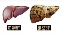 脂肪肝成因&脂肪肝症狀-中醫消除脂肪肝的五招方法:長期脂肪肝可能演變成肝硬化或肝癌記得適當處置!