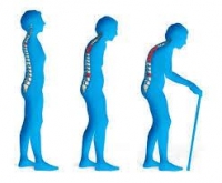 維生素D&骨質疏鬆-五大維生素D缺乏骨質疏鬆症狀:骨質疏鬆症預防!