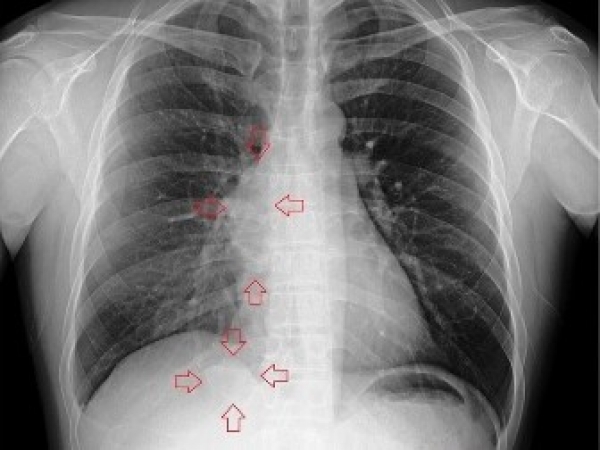 如何早期發現肺癌&amp;肺癌早期會有哪些症狀-肺癌早期九大症狀:肺癌早發現治療是關鍵!