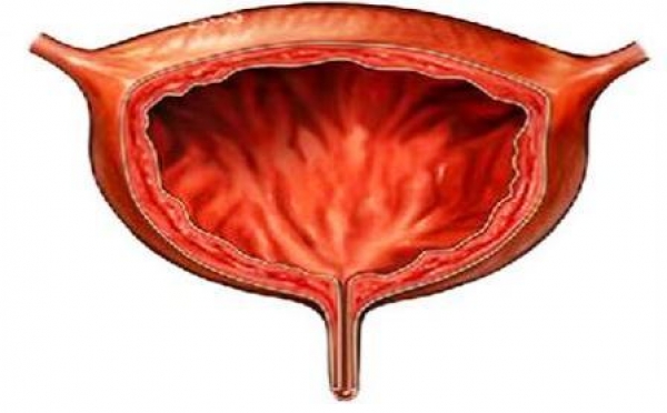 膀胱癌預防&amp;膀胱癌前兆-血尿與膀胱癌的關聯性:血尿的原因,無痛血尿如何預防&amp;治療?