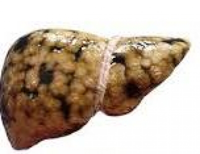 脂肪肝/脂肪肝症狀-三項有效消除脂肪肝:脂肪肝臟易發炎,嚴重甚至變成肝癌不容忽視!