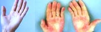 肝病&肝掌-肝症狀攤開手掌看肝臟健康&養肝秘訣:肝好不好看手掌就知道!