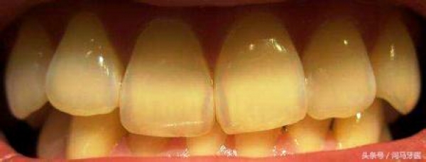 牙石&amp;口腔衛生-三項牙結石因素&amp;三項防治牙石措施:清潔牙齒污垢防治口腔疾病!