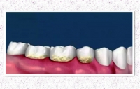 洗牙&牙結石-四個超簡單去牙結石的洗牙方法:在家解決牙結石免去醫院洗牙!